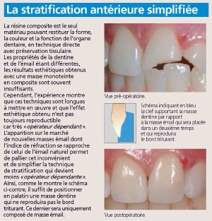 La stratification antérieure simplifiée