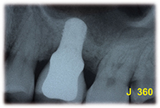 Implant court en situation sous-sinusienne.