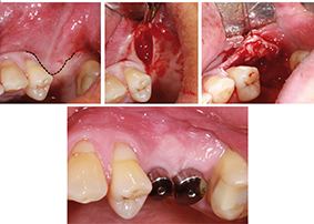 Frénectomie et greffe conjonctive enfouie permettent d’améliorer l’environnement péri-implantaire et de prévenir le risque de péri-implantite.