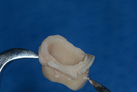 Réadaptation de la couronne transitoire à la résine fluide.