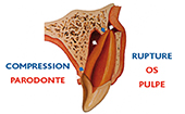 Ischémie pulpaire consécutive à un traumatisme avec fracture osseuse, et/ou une rupture du paquet vasculonerveux, et compression du parodonte.