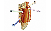 Luxation et son cortège de symptômes :  1. Fracture alvéolaire ;  2. Rupture du paquet vasculo-nerveux ;  3. Compression du ligament parodontal ;  4. Rupture du ligament parodontal 