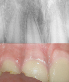 Cas n° 1 : Fractures coronaires avec effraction pulpaire sur 11 et 12.