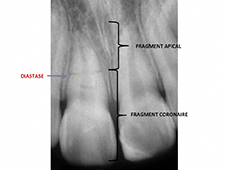 Éléments de diagnostic radiographique.