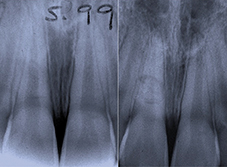 Fracture non visible radiographiquement et visualisée 6 mois après.