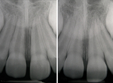 11 immature expulsée, placée dans du lait, réimplantée après 1 heure et 21 luxée. - À gauche, radiographie à 10 jours. - À droite, radiographie à 6 mois : l’oblitération canalaire en cours est visible sur les deux dents.