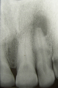 Radiographie d’une dent dont la pulpe s’est nécrosée et infectée et parodontite apicale associée.