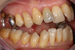 Patient de 58 ans présentant une importante béance antérieure. Les molaires maxillaires doivent être extraites pour raison parodontale.