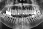Radiographie panoramique objectivant les atteintes parodontales terminales au niveau des molaires maxillaires.