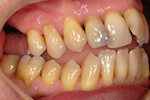 Fermeture spontanée de la béance après extraction des molaires maxillaires. Traitement orthodontique : ingression des molaires mandibulaires et distalisation des dents maxillaires.