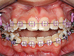Fig. 5. Cas 2 : Fermeture de béance avec ingression des molaires (cas traité par Stephen Tracey).