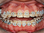 Fig. 6. Cas 2 : Fermeture de béance avec ingression des molaires (cas traité par Stephen Tracey).