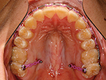 Fig. 8. Cas 2 : Fermeture de béance avec ingression des molaires (cas traité par Stephen Tracey).