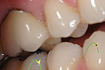 Vue de la sortie de cycle en contact antagoniste dynamique. Le calage a été avancé d’un couple et la cinétique des cycles de mastication est rétablie. La rééducation linguale devra se faire parallèlement au traitement occlusal.