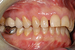 Vue latérale préopératoire mettant en évidence des couronnes devant être remplacées sur les dents 46 et 47, le tout dans un contexte d’important surplomb antérieur.