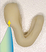 Fig. 1 à 4. - Utilisation d’une butée antérieure qui, associée à la position optimale de la langue, permet de retrouver l’occlusion de déglutition naturelle. Celle-ci est enregistrée à l’aide de bandelettes de cire Moyco® X-Hard et permet un montage sur articulateur.