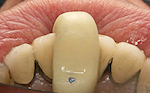 Fig. 1 à 4. - Utilisation d’une butée antérieure qui, associée à la position optimale de la langue, permet de retrouver l’occlusion de déglutition naturelle. Celle-ci est enregistrée à l’aide de bandelettes de cire Moyco® X-Hard et permet un montage sur articulateur.