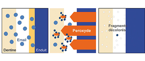 Fig.2 : Le principe d’éclaircissement repose sur les propriétés oxydantes de la décomposition du peroxyde d’hydrogène. En effet, le faible poids des molécules de peroxyde d’hydrogène décomposées leur permet de traverser l’émail et la dentine et de scinder les molécules organiques responsables de la dyschromie. Cette action contribue à la désaturation de la dent et donc à son éclaircissement.