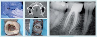cycle long d'endodontie 2015