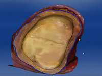 6. Détermination des limites de la préparation (Cerec).