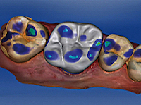 8. Proposition logicielle de couronne en fonction de l’occlusion (Cerec).