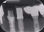 11. Vérification radiographique après vissage du pilier sur l’implant.