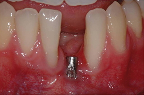 photo 3 : implant à l'épreuve du temps