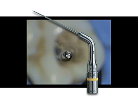 2. Phase 1 – Utilisation de l’insert à ultrasons Satelec ET25 afin de dégager la partie cervicale de l’instrument fracturé.