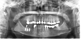 2. Radiographie panoramique du cas clinique 1.