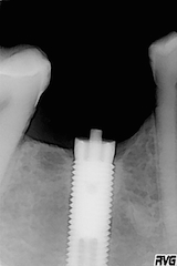 4. Cas clinique 3 – Radiographie d’une tête de vis fracturée.