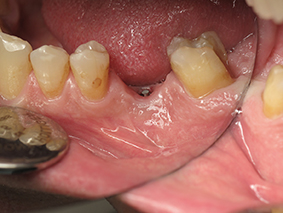 5. Cas clinique 3 - Vue endobuccale de la vis fracturée.