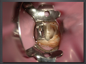 7. Vue clinique après descellement de la moitié vestibulaire de l’inlay-core.