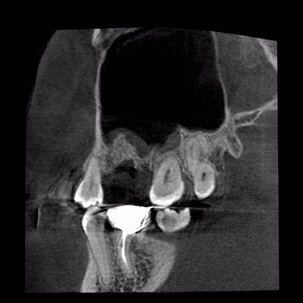 1 - Greffe ou implant court.