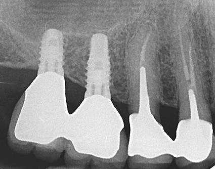 2 - Implant court plutôt que sinus lift.