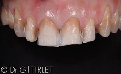 6 - Conserver la structure amélaire de l’organe dentaire.