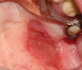Fig.1 : Une ulcération correspond à une perte de substance profonde intéressant tout ou partie du chorion. Le fond de la lésion est en dessous des bords muqueux adjacents non atteints.