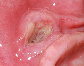 Fig.4 : Ulcération d’origine traumatique.