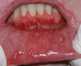 Fig.6 : Aphtose multiple.