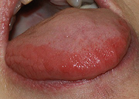 Fig.9 : Candidose aiguë érythémateuse de la langue, apparue après une prescription d’une antibiothérapie à large spectre.