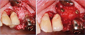 3 - Régénération osseuse et aménagement gingival sont pratiqués.