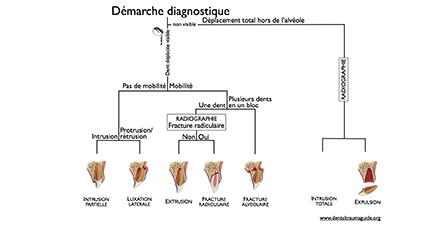 1  - Éléments à prendre en considération dans le cas d’une dent partiellement ou totalement déplacée pour orienter le diagnostic (www.dentaltramaguide.org).