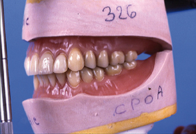 Fig.1 - Prothèse amovible complète traditionnelle.