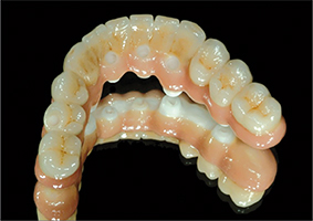 Fig.3 - Prothèse fixée sur implant (praticien J.G. Voiry, prothésiste J.M. Étienne).