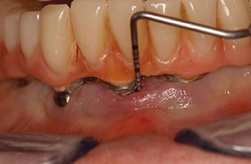 2 - Péri-implantite mise en évidence par sondage et se traduisant par une inflammation de la muqueuse péri-implantaire avec perte osseuse.