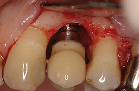 6 - Vue opératoire après débridement et curetage.