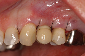 7 - Vue après comblement et suture.