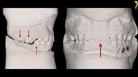 2 - Vérification et traitement de l’occlusion.