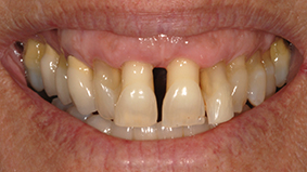 3 -  Présence d’une parodontite.