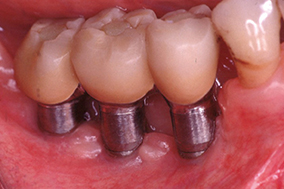 1 & 2 - Suppression de l’inflammation des tissus péri-implantaires après amélioration de l’hygiène.