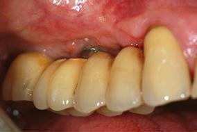 5 & 6 - Amélioration de l’état gingival péri-implantaire obtenue après modification de la structure de contact muqueux permettant l’utilisation efficace de brossettes.